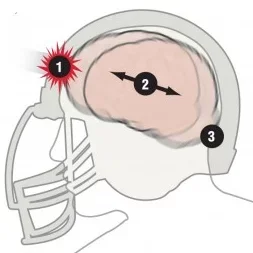 Diagram of a football concussion.